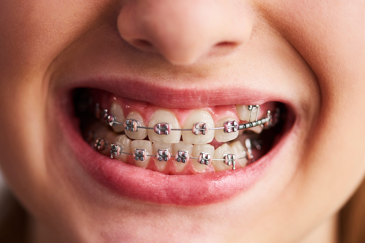 จัดฟันแบบโลหะธรรมดา (Metal Braces)